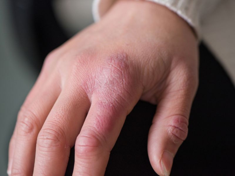 Micoses e Frieiras: O perigo de ficar com o "pé molhado" na chuva