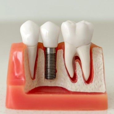 Implante Dentário em São Tomé