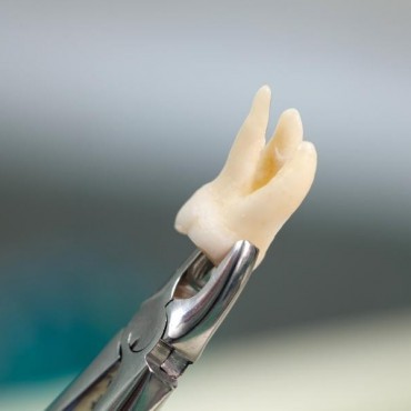 Extração de Dente em São Tomé