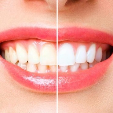 Clareamento Dental em São Tomé